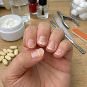 Why Are My Nails Peeling? Common Causes and Simple Fixes