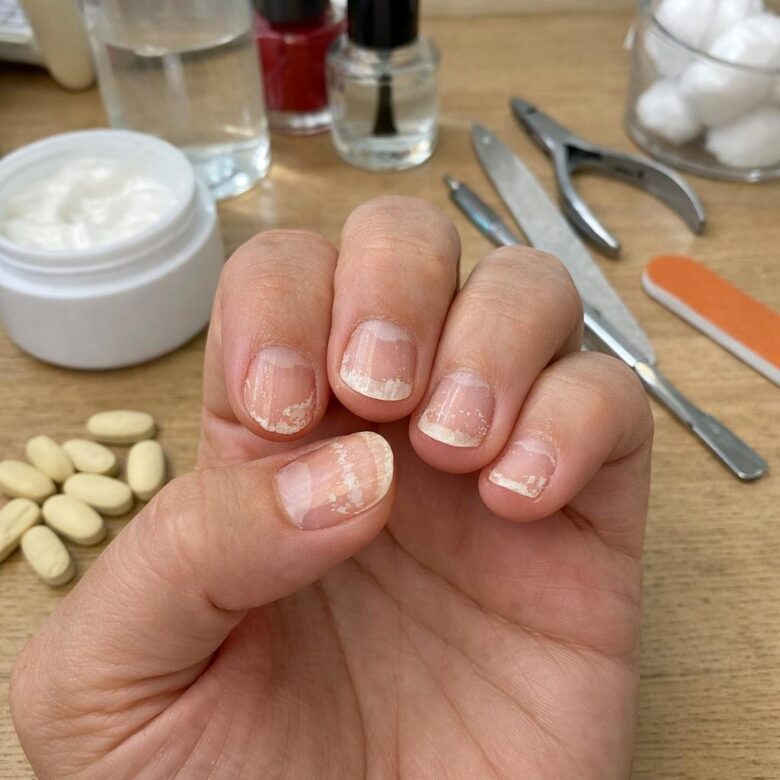Why Are My Nails Peeling? Common Causes and Simple Fixes